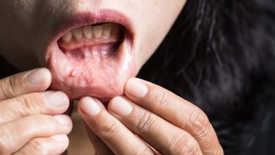 أعراض سرطان الفم.. علامات تحذيرية يجب عدم تجاهلها