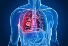 الالتهاب الرئوي Pneumonia.. الأسباب والأعراض والعلاج