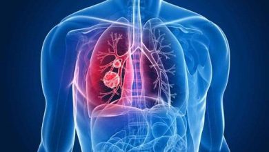 الالتهاب الرئوي Pneumonia.. الأسباب والأعراض والعلاج