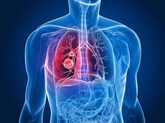 الالتهاب الرئوي Pneumonia.. الأسباب والأعراض والعلاج