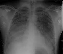 متلازمة الالتهاب التنفسي الحاد Acute Respiratory Distress Syndrome – ARDS.. الأسباب والعلاج