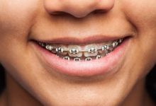 تقويم الأسنان.. دليلك الشامل لفهم الفوائد والإجراءات