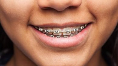 تقويم الأسنان.. دليلك الشامل لفهم الفوائد والإجراءات