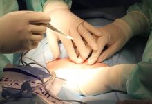 العملية القيصرية (C-Section).. كل ما تحتاج معرفته