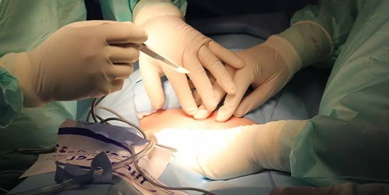 العملية القيصرية (C-Section).. كل ما تحتاج معرفته