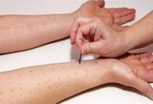 اختبار حساسية الجلد (Allergy Skin Test).. أهمية وطريقة إجراء الفحص