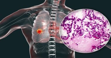 دراسة تكشف سبب انتشار مرض السرطان إلى الرئتين وطرق منع المضاعفات