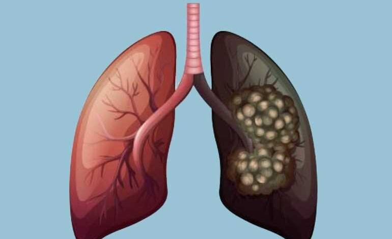 سرطان الرئة.. أعراض يجب الانتباه لها مبكرًا لتفادي التشخيص المتأخر سرطان الرئة.. أعراض يجب الانتباه لها مبكرًا لتفادي التشخيص المتأخر