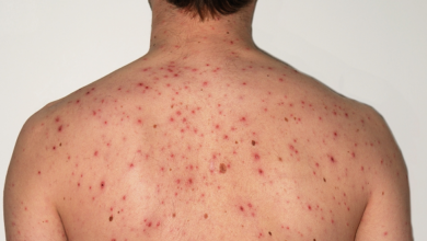 ارتفاع حالات الحصبة في كارولاينا الجنوبية مع استمرار التفشي وتهديد القضاء على المرض في أمريكا ارتفاع حالات الحصبة في كارولاينا الجنوبية مع استمرار التفشي وتهديد القضاء على المرض في أمريكا